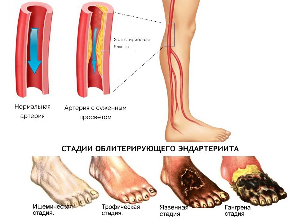 Облитерирующий эндартериит сосудов ног