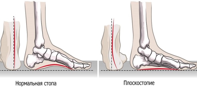 Плоскостопие