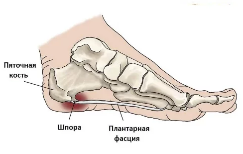 Фасциит стопы. Пяточная шпора