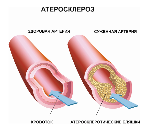 Атеросклероз сосудов ног